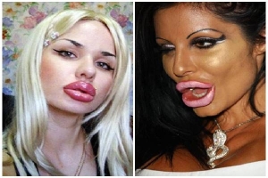 Những cặp môi 'ám ảnh' nhất thế giới do lạm dụng phẫu thuật thẩm mỹ bơm môi