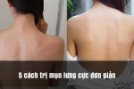 5 cách trị mụn lưng cực đơn giản