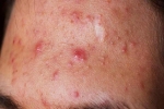 5 loại mụn trên da dù có ngứa thế nào cũng tuyệt đối không được nặn
