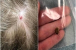 Chỉ vì một vết côn trùng cắn nhỏ xíu trên đầu, bé 5 tuổi bị liệt và không thể nói suốt 12 giờ