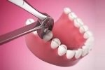 Cách phòng tránh nguy cơ nhổ răng bất đắc dĩ