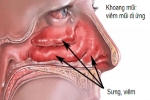 Viêm mũi dị ứng dễ nhầm với viêm xoang: Chuyên gia tai mũi họng chỉ cách phân biệt
