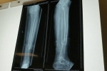 Yêu cầu 'kỳ lạ', người phụ nữ gãy chân bị nhiều bệnh viện từ chối