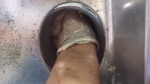 Nữ bệnh nhân nhập viện cấp cứu với bàn tay bị kẹt trong máy xay thịt