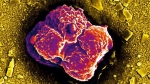 Tại sao tế bào ung thư lan rất nhanh khắp cơ thể?
