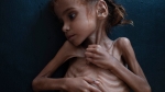 Bé gái suy dinh dưỡng - biểu tượng của nạn đói Yemen đã qua đời