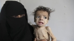 Tình cảnh không thể tồi tệ hơn của những 'bộ xương di động' ở Yemen
