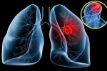 Hơn 20.000 người Việt chết vì ung thư phổi mỗi năm