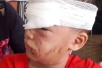 Bé trai 6 tuổi ở Thanh Hóa bị chó nhà cắn rách mặt