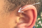 Tại sao một số người có lỗ nhỏ trên vành tai?