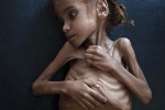 Bé gái trơ khung xương gây chấn động về nạn đói ở Yemen