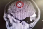 Bác sĩ lôi ký sinh trùng 15cm trong não bé trai, cảnh báo thói quen xấu khi ăn uống