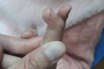 Bé 6 tuổi không duỗi được ngón tay vì tự chữa tại nhà