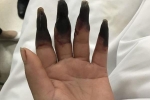 Hai bàn tay bị hoại tử đen sì vì lý do nhiều người vẫn hay mắc phải
