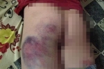 Đắk Lắk: Học sinh lớp 4 bị đánh bầm mông vì... không biết viết
