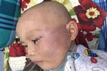 Bé trai 19 tháng tuổi bị bảo mẫu tát sưng mặt