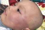 Vụ bé trai 19 tháng bị tát sưng mặt: Đề nghị xử lý bảo mẫu