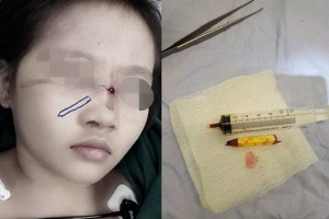 Tai nạn kinh hoàng cận Tết: Cầm bút chì chơi rồi vấp ngã, bé gái 6 tuổi bị đâm xuyên từ mũi đến hốc mắt