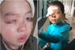 Điều tra vụ học sinh tiểu học bị chấn thương mắt nghi do cô giáo đánh