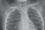'Trái tim vàng' trên ảnh X-quang của bé gái