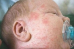 3 triệu chứng giúp phát hiện bệnh sởi sớm, phân biệt sởi với sốt phát ban