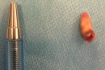 Đột nhiên mất khứu giác, người đàn ông đi khám bác sĩ thì phát hiện có chiếc răng mọc trong mũi