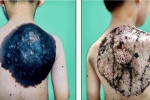 Bé trai 7 tuổi mang khối u hắc tố khổng lồ trên lưng như chiếc mai rùa