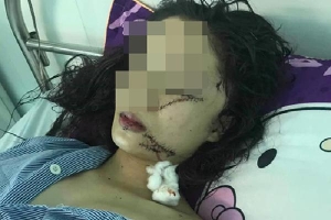 Thiếu nữ bị ba bạn gái vây đánh, rạch mặt trong đêm