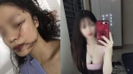 Công an thông tin CHÍNH THỨC vụ cô gái trẻ xinh đẹp Bắc Giang bị r ạch mặt ch ằng chịt, khâu 60 mũi