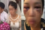 Xôn xao thông tin cô dâu bị đánh bầm mắt vì từ chối chồng hôn trong đám cưới