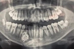 Hi hữu: Lấy gần 100 cái răng trong miệng một thiếu niên ở Khánh Hòa