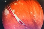 Bác sỹ lấy bàn chải 14 cm ra khỏi dạ dày của bệnh nhân Trung Quốc