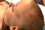 Bé trai 6 tháng tuổi bị chảy máu não, nghi do bảo mẫu bạo hành