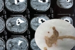 Đau đầu đi cấp cứu, phát hiện 5 ổ sán lớn nằm trong não người đàn ông ăn tiết canh