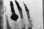 Sự thật cay đắng phía sau tấm ảnh chụp X-quang đầu tiên trên thế giới