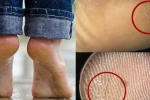 Nhập viện vì gót chân quá đau đớn, bệnh nhân không ngờ thủ phạm lại là sợi tóc mỏng manh dài 1 cm
