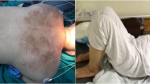 Hà Nam: Người phụ nữ đột ngột liệt nửa người sau khi đi giác hơi, bấm huyệt