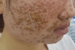 Tổn thương da sau hai lần rửa mặt bằng loại bột lạ
