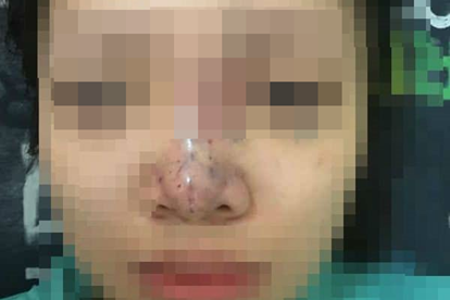 Trường hợp bệnh nhân gặp biến chứng sau khi nâng mũi.