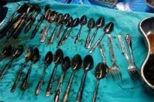 Ca mổ hy hữu lấy ra 20 chiếc thìa dĩa và nữ trang trong dạ dày người bệnh