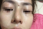 Giấu bố mẹ đi nâng mũi, bé gái 13 tuổi ở Yên Bái bị mù 1 mắt