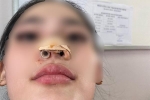 Đi nâng mũi tại spa, thiếu nữ 16 tuổi ở TP.HCM bị nhiễm trùng, biến dạng nặng nề đầu mũi