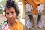 Dị nhân Ấn Độ có đến 31 ngón tay ngón chân