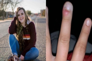 Cô gái 18 tuổi suýt mất ngón tay do thói quen xấu mà ai cũng dễ mắc phải