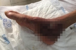 Người đàn ông suýt mất chân do tự đắp thuốc nam tại nhà