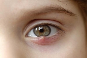 8 dấu hiệu cảnh báo bệnh tật được 'khắc' rất rõ trên mắt: Ai cũng cần đọc để đối chiếu với sức khỏe bản thân