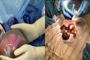 Ca sinh đôi hy hữu: Hai bé gái chào đời ở tuần 22, còn nguyên trong bọc ối