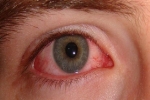 Đau mắt đỏ nhẹ có phải là một trong các triệu chứng để nhận biết người mắc Covid-19?