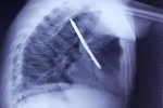 Mổ khẩn cấp cứu sống bệnh nhân bị tuốc nơ vít cắm sâu trong phổi