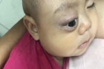 Xót thương bé trai dân tộc Nùng 7 tháng tuổi bị khối u đẩy lồi mắt ra ngoài
